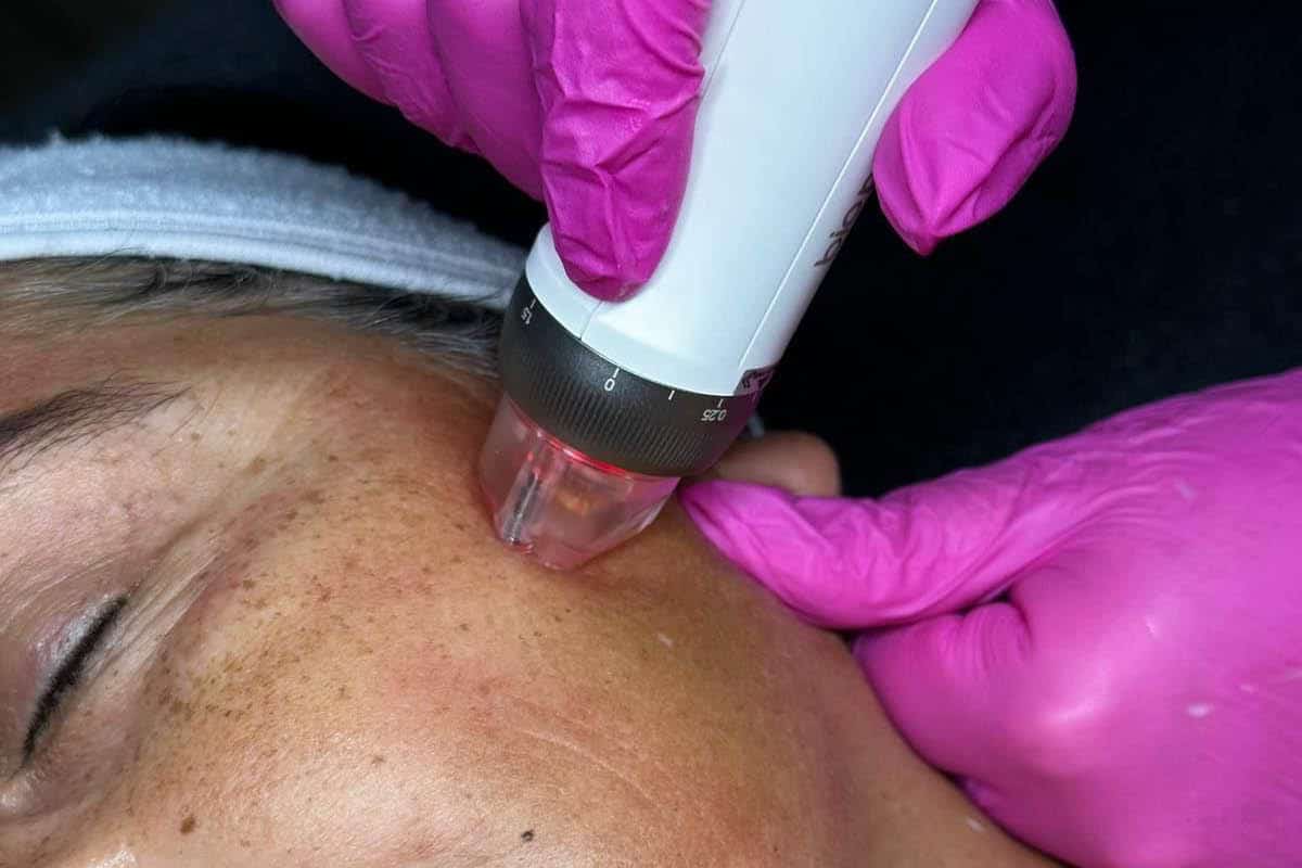 Skin needling at Chakra