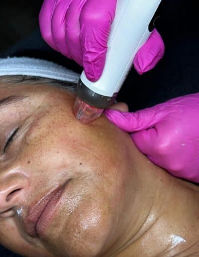 skin needling